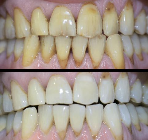 Bleaching | professionelle Zahnaufhellung Bleaching | professionelle Zahnaufhellung