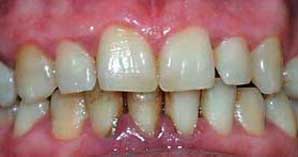 Zahnstein und Beläge Zahnstein und Beläge